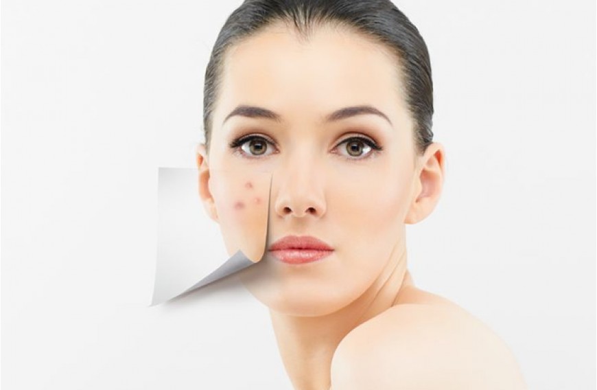Acne - how to get rid of acne forever?